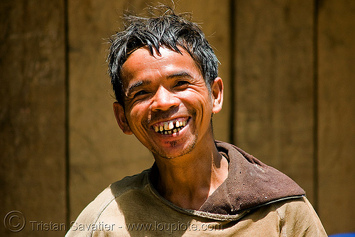 bad teeth, good smile - villager (laos), bad teeth, decayed teeth, guy, man