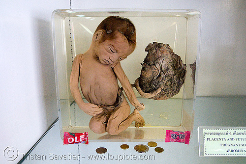 dead human fetus, preserved - ศพเด็ก - forensic medicine museum, โรงพยาบาลศิริราช - siriraj hospital, bangkok (thailand), anatomy, bangkok, cadaver, corpse, dead baby, dead fetus, death, forensic medicine museum, human remains, jar, placenta, siriraj hospital, womb, บางกอก, ศพเด็ก, โรงพยาบาลศิริราช