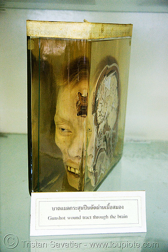 half human head, preserved - forensic medicine museum, โรงพยาบาลศิริราช - siriraj hospital, bangkok (thailand), anatomy, bangkok, beheaded, brain, cadaver, corpse, dead, death, decapitated, forensic medicine museum, human head, human remains, jar, real severed head, section, siriraj hospital, specimen, บางกอก, โรงพยาบาลศิริราช
