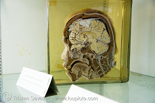 section of human head, preserved - forensic medicine museum, โรงพยาบาลศิริราช - siriraj hospital, bangkok (thailand), anatomy, bangkok, beheaded, brain, cadaver, corpse, dead, death, decapitated, forensic medicine museum, human head, human remains, jar, real severed head, section, siriraj hospital, specimen, บางกอก, โรงพยาบาลศิริราช