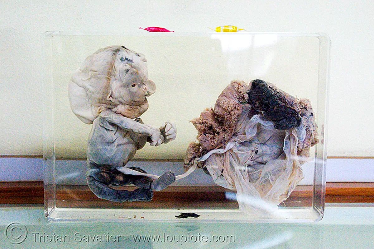 damaged and partly decomposed fetus, preserved, ศพเด็ก, forensic