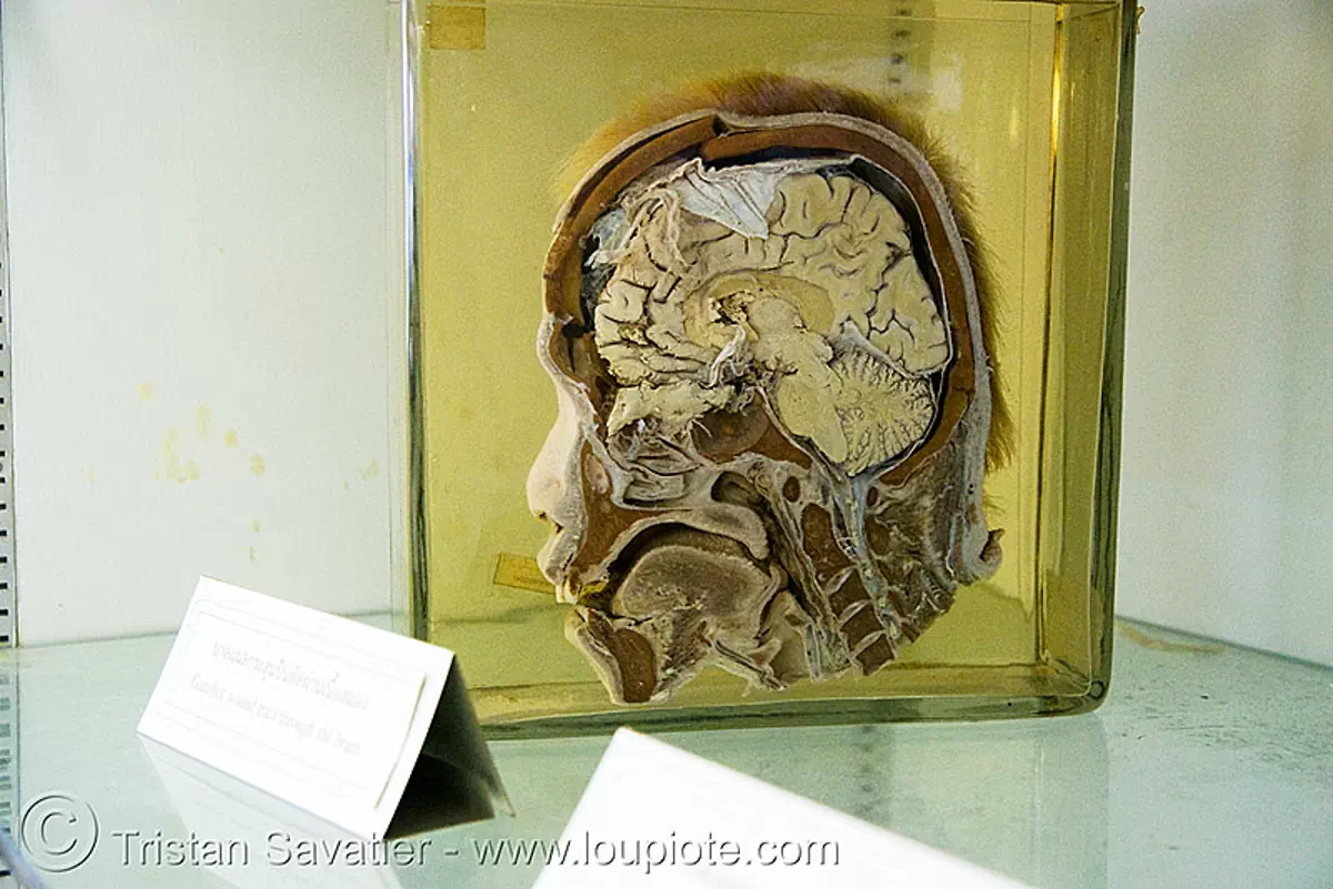 section of human head, preserved, forensic medicine museum, โรงพยาบาล