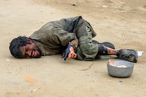 beggar with horrific skin burn and necrosis (india), bank notes, beggar, bowl, burned, hand, hindu pilgrimage, hinduism, injury, kumbh mela, laying down, leg, man, money, necrosis, offerings, pain, painful, skin disease, slough, sloughy, suffering, victim