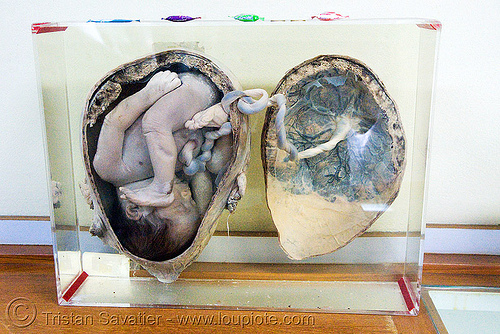 dead fetus in womb, preserved - ศพเด็ก - forensic medicine museum, โรงพยาบาลศิริราช - siriraj hospital, bangkok (thailand), anatomy, bangkok, cadaver, corpse, dead baby, dead fetus, death, forensic medicine museum, human remains, jar, placenta, siriraj hospital, specimen, womb, บางกอก, ศพเด็ก, โรงพยาบาลศิริราช