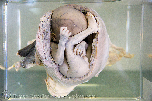 dead fetus in womb, preserved - ศพเด็ก - forensic medicine museum, โรงพยาบาลศิริราช - siriraj hospital, bangkok (thailand), anatomy, bangkok, cadaver, corpse, dead baby, dead fetus, death, forensic medicine museum, human remains, placenta, siriraj hospital, specimen, thailand, womb, บางกอก, ศพเด็ก, โรงพยาบาลศิริราช