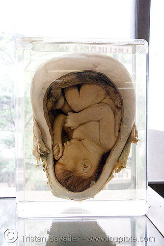 dead fetus in womb, preserved - ศพเด็ก - forensic medicine museum, โรงพยาบาลศิริราช - siriraj hospital, bangkok (thailand), anatomy, bangkok, cadaver, corpse, dead baby, dead fetus, death, forensic medicine museum, human remains, placenta, siriraj hospital, specimen, thailand, womb, บางกอก, ศพเด็ก, โรงพยาบาลศิริราช