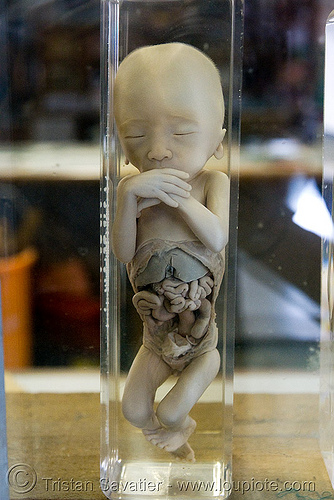 dead fetus, preserved - ศพเด็ก - forensic medicine museum, โรงพยาบาลศิริราช - siriraj hospital, bangkok (thailand), anatomy, bangkok, cadaver, corpse, dead baby, dead fetus, death, forensic medicine museum, human remains, siriraj hospital, specimen, thailand, บางกอก, ศพเด็ก, โรงพยาบาลศิริราช
