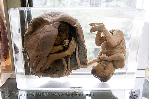 dead twin fetuses, preserved - ศพเด็ก - forensic medicine museum, โรงพยาบาลศิริราช - siriraj hospital, bangkok (thailand), anatomy, bangkok, cadaver, corpse, dead babies, dead fetus, death, fetuses, forensic medicine museum, human remains, placenta, siriraj hospital, thailand, twins, womb, บางกอก, ศพเด็ก, โรงพยาบาลศิริราช