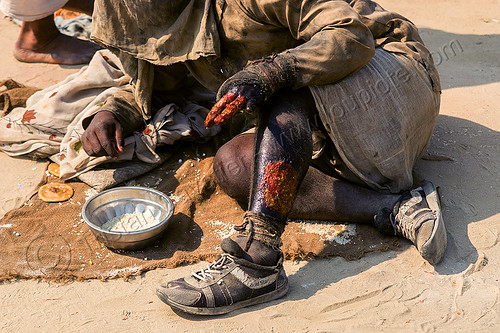 man with skin disease and necrosis (india), beggar, burned, fingers, hindu pilgrimage, hinduism, injury, kumbh mela, leg, man, mand, necrosis, skin disease, slough, sloughy, victim