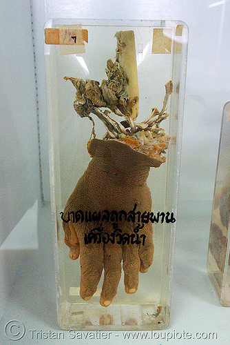 severed hand, preserved - forensic medicine museum, โรงพยาบาลศิริราช - siriraj hospital, bangkok (thailand), anatomy, bangkok, body part, cadaver, corpse, dead, death, forensic medicine museum, human remains, jar, severed hand, siriraj hospital, specimen, บางกอก, โรงพยาบาลศิริราช