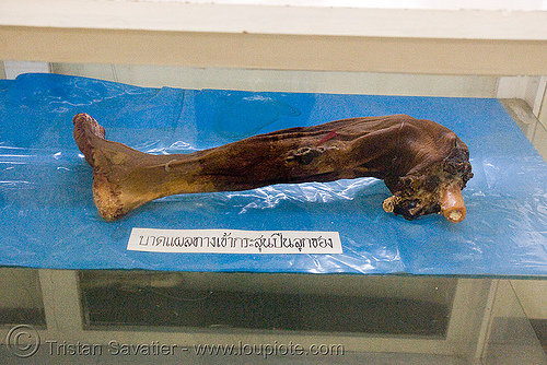 severed human leg, preserved - forensic medicine museum, โรงพยาบาลศิริราช - siriraj hospital, bangkok (thailand), anatomy, bangkok, body part, cadaver, corpse, dead, death, foot, forensic medicine museum, human remains, severed leg, siriraj hospital, บางกอก, โรงพยาบาลศิริราช