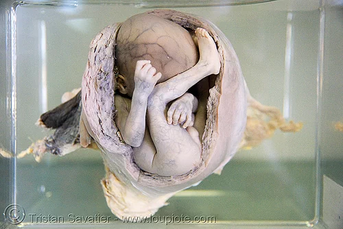 dead fetus in womb, preserved - ศพเด็ก - forensic medicine museum, โรงพยาบาลศิริราช - siriraj hospital, bangkok (thailand), anatomy, bangkok, cadaver, corpse, dead baby, dead fetus, death, forensic medicine museum, human remains, jar, placenta, siriraj hospital, specimen, womb, บางกอก, ศพเด็ก, โรงพยาบาลศิริราช
